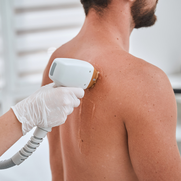 hair removal men